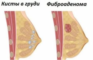 Может ли киста молочной железы перерасти в фиброаденому молочной железы