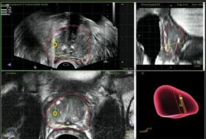 Fusion биопсия предстательной железы под контролем мрт