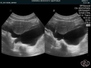 Жидкость в трубах матки на узи