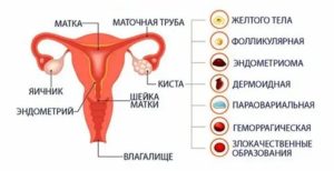 Какие бывают кисты яичника виды и симптомы