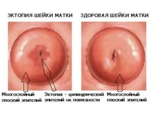 Цитологическая картина эктопии шейки матки что это такое