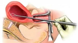 Сколько идут выделения после выскабливания при эндометриозе