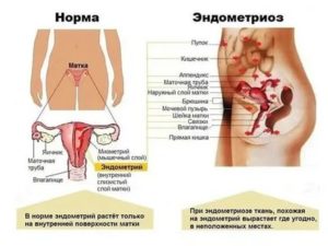Эндометриоз болит низ живота у женщины что это может быть
