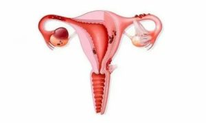 Может ли быть эндометриоз если гормоны в норме