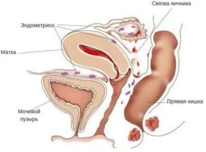 Может ли при эндометриозе подниматься температура