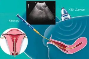 Как проверить проходимость маточных труб с помощью узи стоимость