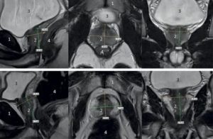 Анатомия предстательной железы по мрт