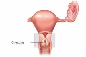 Рак шейки матки это объемное образование
