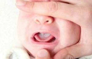 Молочница во рту у грудничка лечение облепиховым маслом