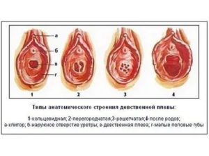 Девственная плева можно ли увидеть на узи