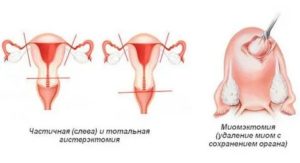 Может ли миома уменьшится в размерах при климаксе