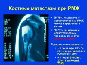 Продолжительность жизни при метастазах в костях при раке молочной железы