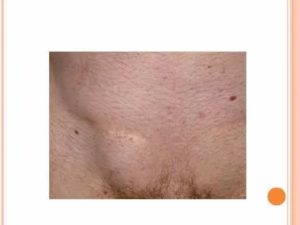 Могут ли воспаляться лимфоузлы при эндометриозе