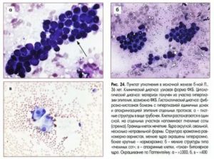 Что показывает цитология кисты молочной железы