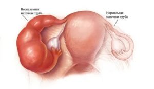 Тубоовариальная воспалительная опухоль лечение
