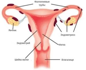 Может ли при эндометриозе подниматься температура