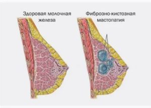 Что такое псевдокисты молочных желез