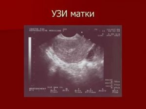 Что показывает узи матки и какие заболевания можно выявить