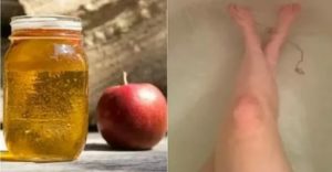 Сосновый уксус и бальзам римский при молочнице