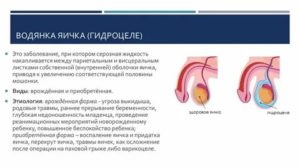 Водянка яичка мочегонные препараты