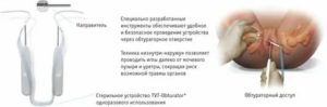 Пластику наружного отверстия уретры гелем гиалуроновой кислоты