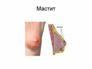 Молочница молочных желез при грудном вскармливании симптомы и лечение