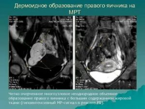 Мрт и жидкостное образование яичника