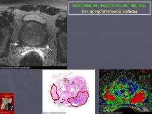 Что такое распад раковой опухоли простаты