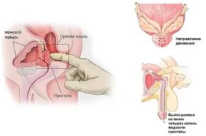 Чихаю и сводит простату
