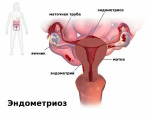 Эндометрий при эндометриозе как улучшить перед эко