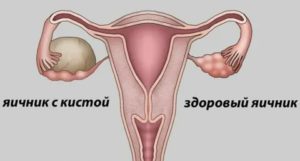 Можно ли делать эко при эндометриозе яичников