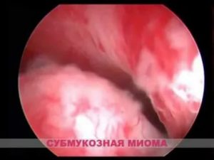 Эндометриоз аденомиоз миому полипы эндометрия