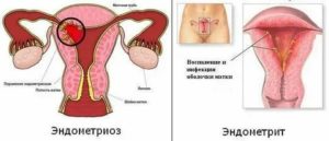 Беременность после лечения эндометрита и эндометриоза