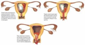 Какие могут быть причины если не пришли месячные после аборта