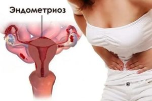 Коричневые выделения эндометриоз тела матки