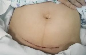 Климакс после кесарева сечения