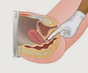 Введение препаратов во влагалище