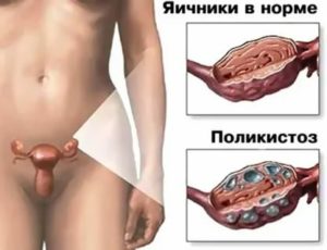 Может ли у подростка быть поликистоз яичников