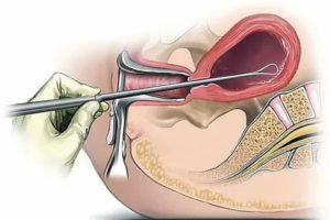 Выскабливание матки при миоме и эндометриозе