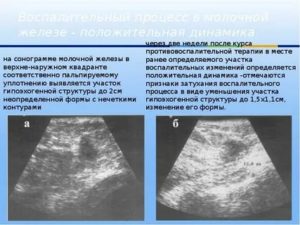 Гипоэхогенный участок с нечеткими контурами в предстательной железе