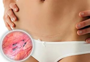 Как лечить эндометриоз матки в домашних условиях после кесарева сечения