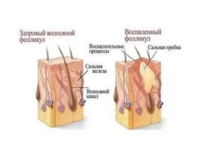 Фолликулит в паху лечение мазь