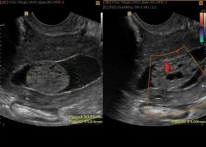 Видно ли на узи образования на шейке матки