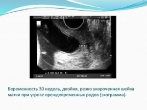 Узи шейки матки при беременности двойней