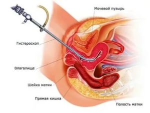 Состояние после гистероскопии матки с выскабливанием