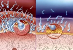 Мукоза при кандидозе