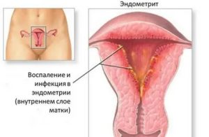 При молочнице может быть белый налет на клиторе