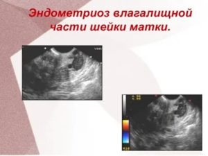 Лечение эндометриоза влагалищной части шейки матки