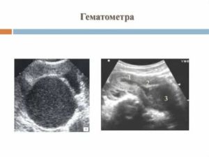 Гематометра что это лечение таблетками