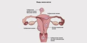 Лечение содой при миоме матки неумывакин